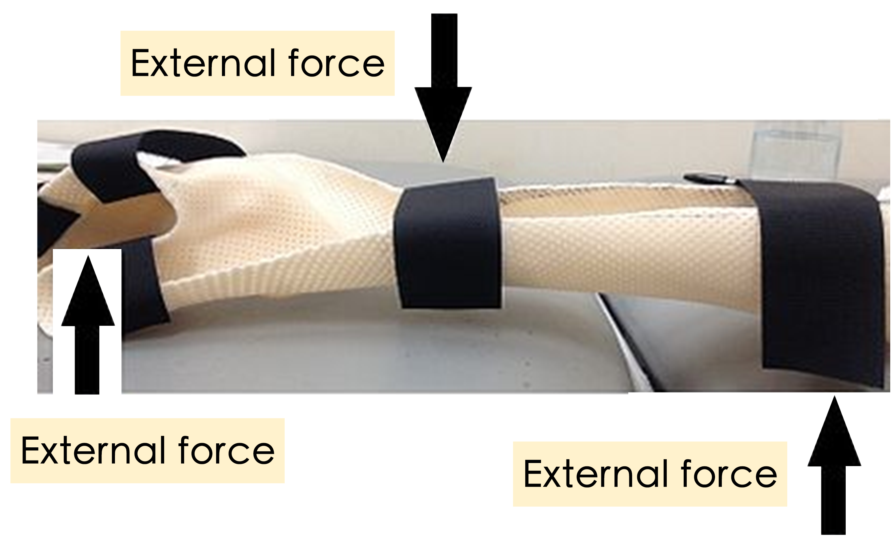 A right hand static splint and illustrate the “external traction” mechanical principle